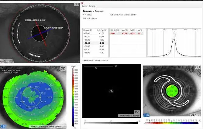 Еволюція та розвиток хірургії катаракти: платформа MS39-OSIRIS CSO